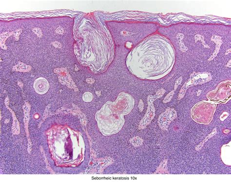 seborrheic keratosis pathology outlines